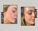 کرم ضد لک اوردینری مدل azelaic acid 10%